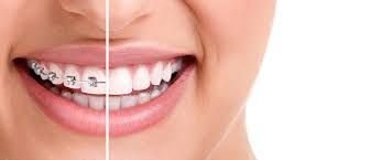 teeth with braces on one side to compare