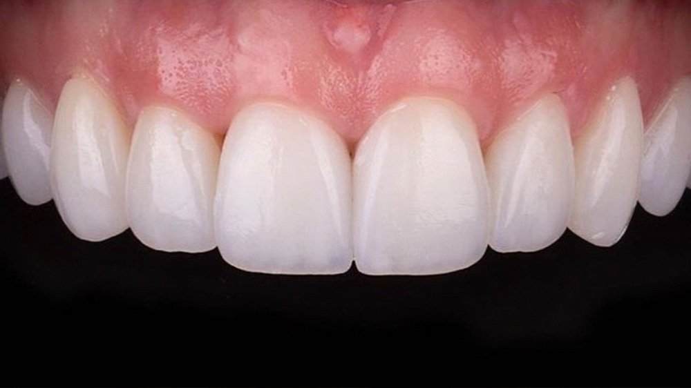 veneer